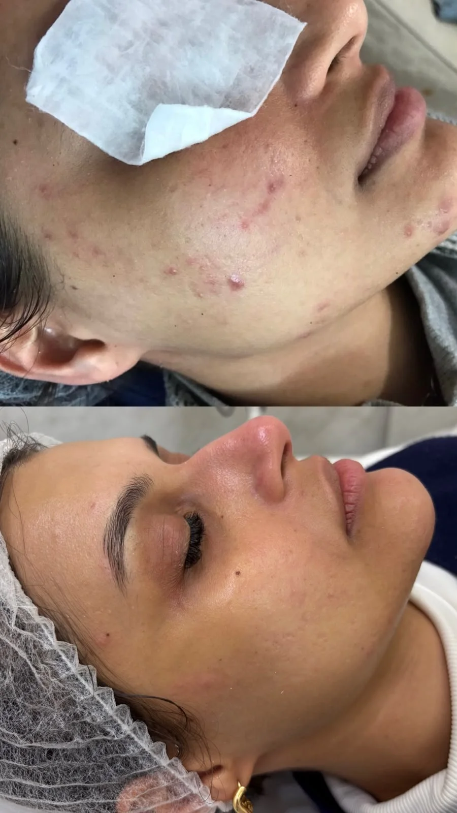 Antes e depois de tratamento para acne na clínica Dra. Mikaela Santos