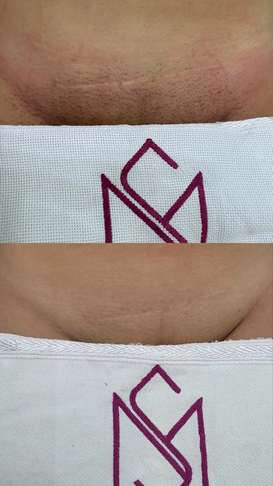 Antes e depois de depilação a laser
