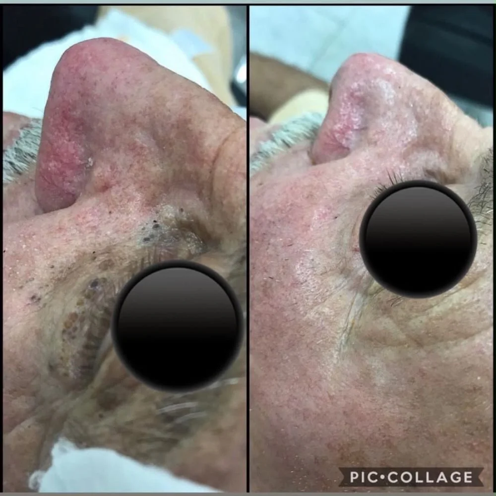 Registros da evolução após limpeza de pele