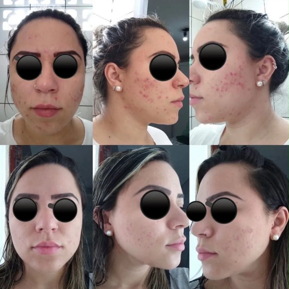 Registros da evolução de cuidados para acne
